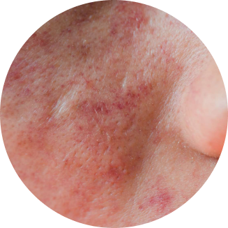 eczema