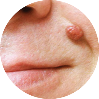 moles