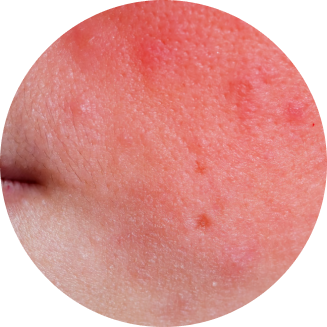 rashes