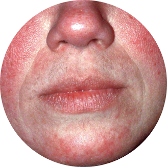 rosacea