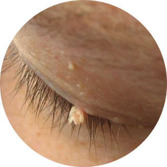 warts